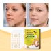 Ximonth Bee Venom Wart Patch Improves Smooth Skin, Removes Moles, Condyloma Warts, Filamentous Warts And Wart Patches_voghion.com