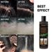 Hair Shampoo For Tinea Capitis Antipuriticprofessional Antidandruff Remove Mites Andrelieve Itching Shampoo 100ml Party Favours_voghion.com