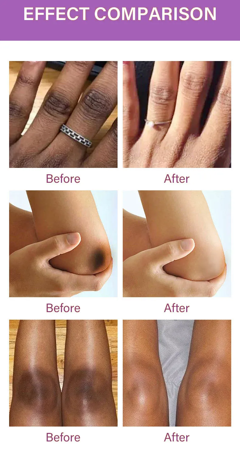 Airongsie Hand Joint Blackening Essence Knee Ankle Brightening Skin Tone Fading Black Original Liquid_voghion.com