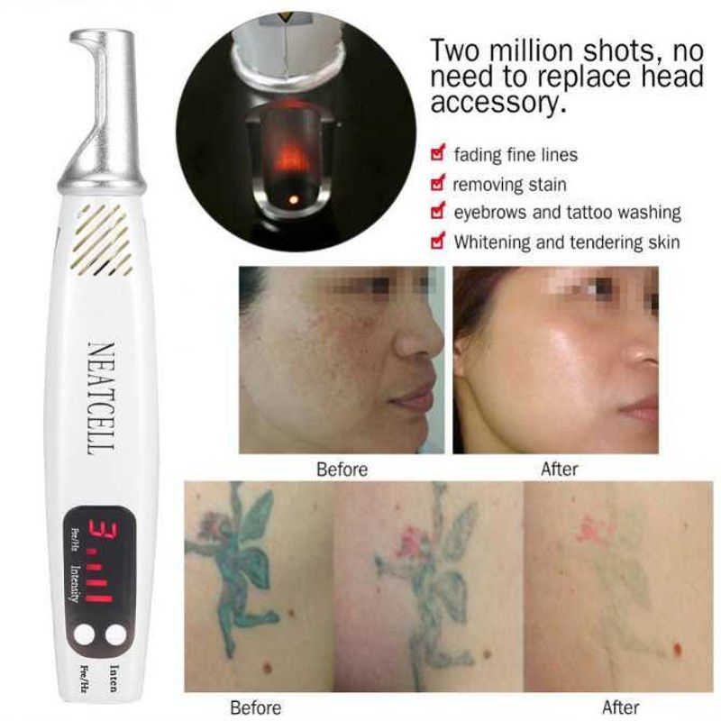 Håndheald Red Light Picosecond Laser Pen Ar Tatovering Fjernelse Melanin Dilute Device + Repair Set - intl_voghion.com