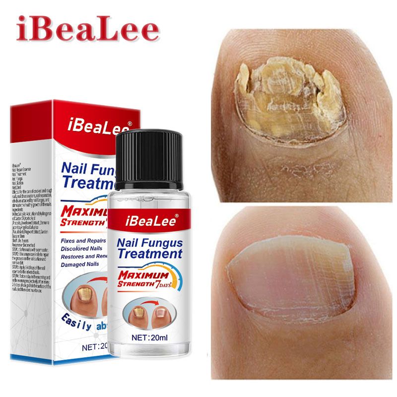 IBeaLee Cremă antibacteriană lichidă pentru îndepărtarea unghiilor, poțiune specială pentru îngroșarea unghiilor gri moi_voghion.com