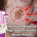 Beauty Care shop Freckle Niacinamide Whitening Cream Remove Melasma Fade Melanin Dark Spots Pigmentation Moisturizing Brighteni_voghion.com