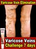 Trattamento efficace delle vene varicose Unguento per le gambe dei lombrichi per alleviare il dolore dei ragni Vasculite Flebite Trattamento del dolore_voghion.com