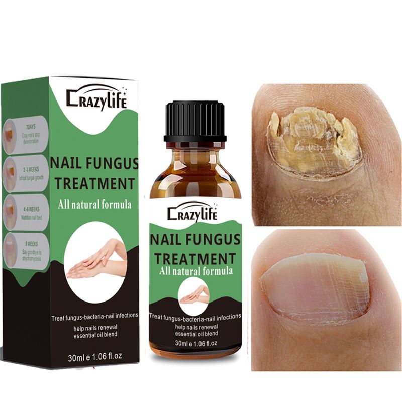 Nagelreparaturlösung Zehennagel-Nagelbehandlung Nagelbehandlung Erneuerung beschädigter, verfärbter Fuß- und Zehennägel Nagelpflegeessenz Nagelreparaturanwendung_voghion.com
