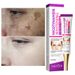 Nicotinamide Whitening Freckle Removing Cream Effectively Remove Melasma Dark Spot Acne Marks Lightening Melanin Face Skin Care_voghion.com