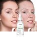 Anti-Acne Serum, Acne, Puistjes en Verstopte Poriën Behandeling Essence -30ml_voghion.com