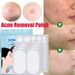 Adesivo invisibile brufolo Patch per il trattamento della rimozione dell'acne idrocolloidale Impermeabile per la rimozione della testa nera Pelle del viso C_voghion.com