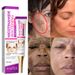 Nicotinamide Whitening Freckle Removing Cream Effectively Remove Melasma Dark Spot Acne Marks Lightening Melanin Face Skin Care_voghion.com