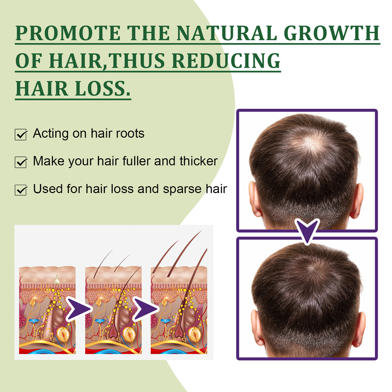 OUHOE Growth Pump Solution Nourishing Scalp, Dense Strong Anti Broken Hair, Sparse and Fixed Hair Nutrition Liquid_voghion.com