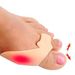 Silikon Big Toe Hallux Valgus Correctors Separatorer Bunion Relief Plattång_voghion.com
