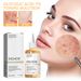 EELHOE Glycolic Acid 7% Toner Removal, Fading Acne Marks, Removing Closed Acne, Repairing Skin Moisturizing and_voghion.com