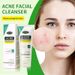 Reinigers Engels ACNE GEZICHTSREINIGER Acne Reiniger Hydraterende Reiniger Huidverzorgingsproducten_voghion.com