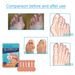 Ximonth Corrective Foot Patch Relieves Hallux Valgus Joint Pain And Swelling Foot Care Corrective Foot Patch_voghion.com