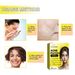 Jaysuing Acne Hydrocolloid Patch For Cleansing Facial Acne, Closing Mouth And Removing Blackheads Delicate Skin Patch_voghion.com