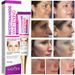 Beauty Care shop Freckle Niacinamide Whitening Cream Remove Melasma Fade Melanin Dark Spots Pigmentation Moisturizing Brighteni_voghion.com