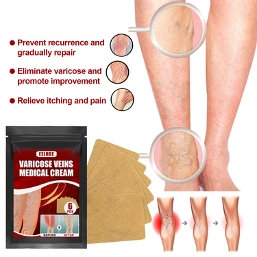 eelhoe vein massage varicose plaster patch leg swelling earthworm leg vein massage relieves pain_voghion.com