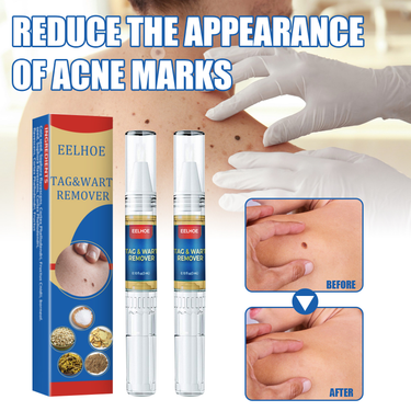 Skin wart removal pen for removing moles and body warts and warts skin repair and care solution_voghion.com