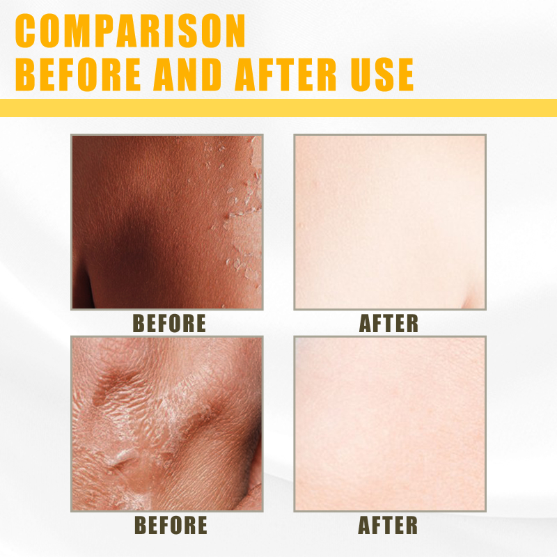 Giel Peeling Ueleg Däischter Haut Bleechung Ewechzehuelen Aarm Knéi Been Melanin Kierper Peeling Brightening Whitening Beauty S_voghion.com
