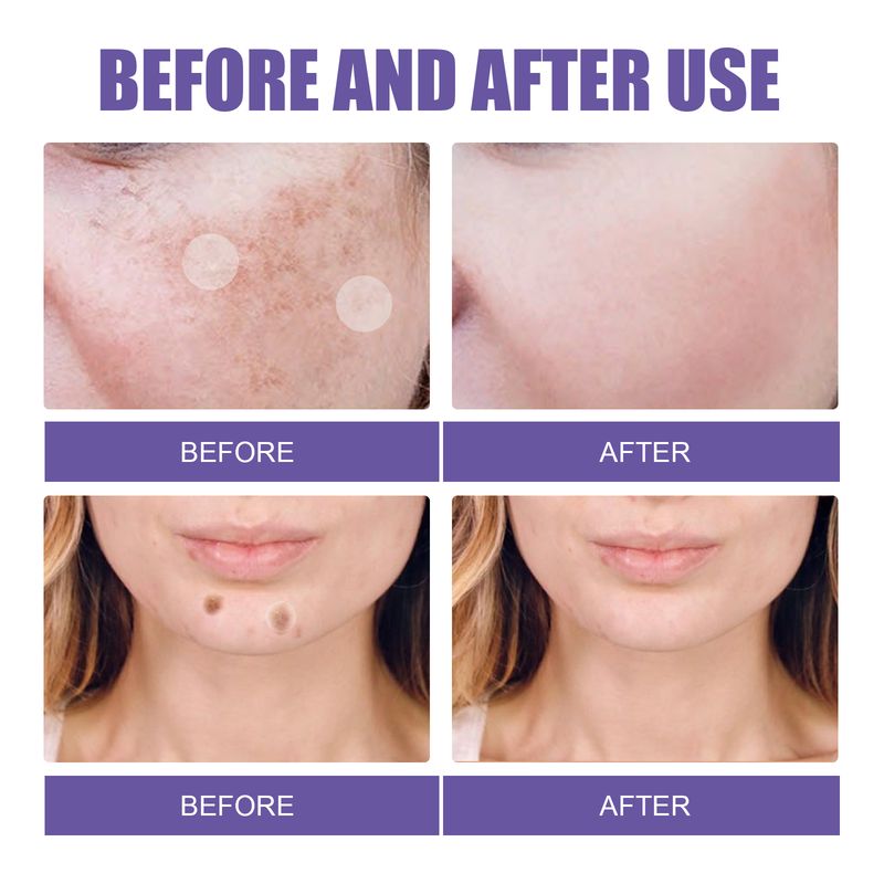 EELHOE Patch zur Entfernung dunkler Flecken, Aufhellung dunkler Flecken im Gesicht, Melasma-Flecken, Melanin, feuchtigkeitsspendendes, aufhellendes Patch zur Hautfleckenentfernung_voghion.com