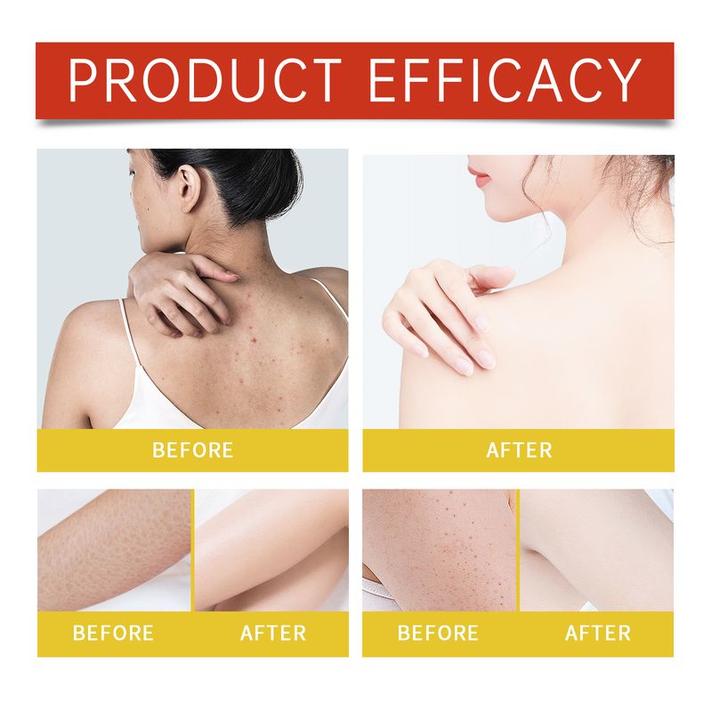 Jaysuing Acne Cleansing Soap Gently Cleanses Back Pimples Smooth And Refreshing Cleansing Soap_voghion.com