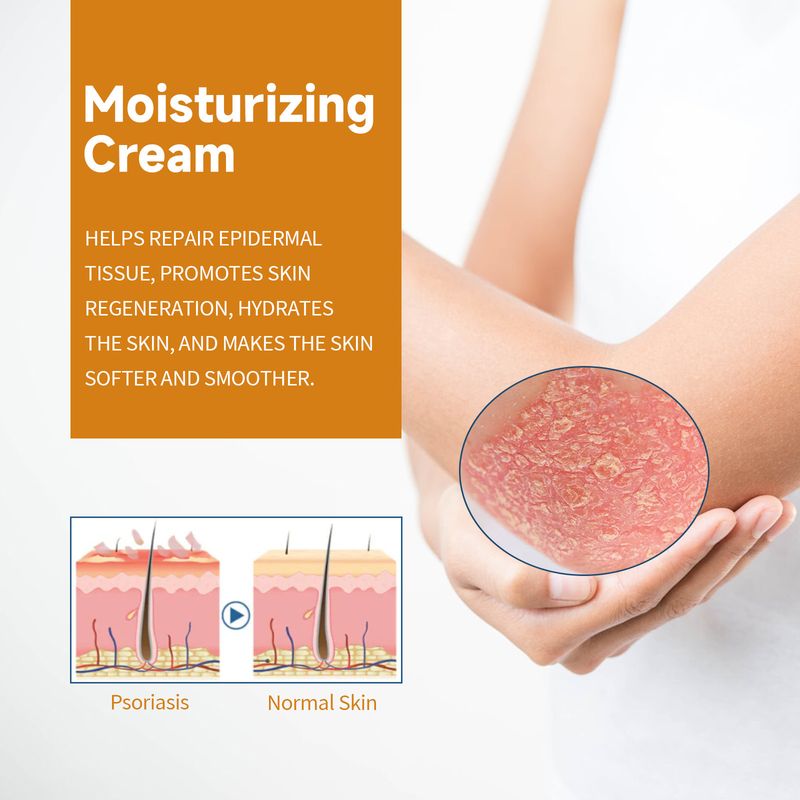 South moon cowhide moss for itching, redness, swelling, moisturizing and repairing skin care cream_voghion.com