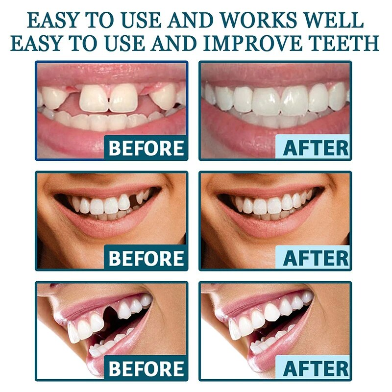Set regolabile Impiallacciatura sorridente istantanea Sbiancamento denti per protesi Decora gli spazi tra i denti_voghion.com