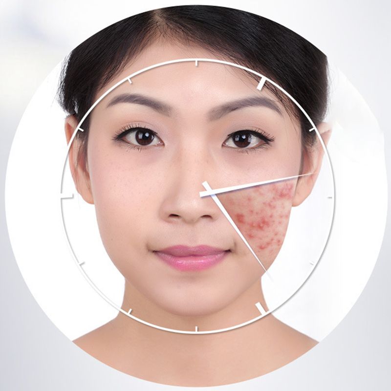 30 g Acne Comedo Pimples noņemšanas poru samazinošs mitrinošs ādas kopšanas krēms_voghion.com