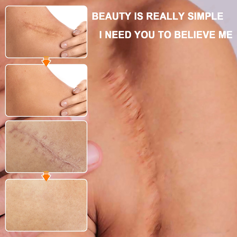 EELHOE Narbe zur Aufhellung postoperativer Narben, zur Glättung der Haut, zur Reparatur und Befeuchtung der Hautpflegecreme_voghion.com