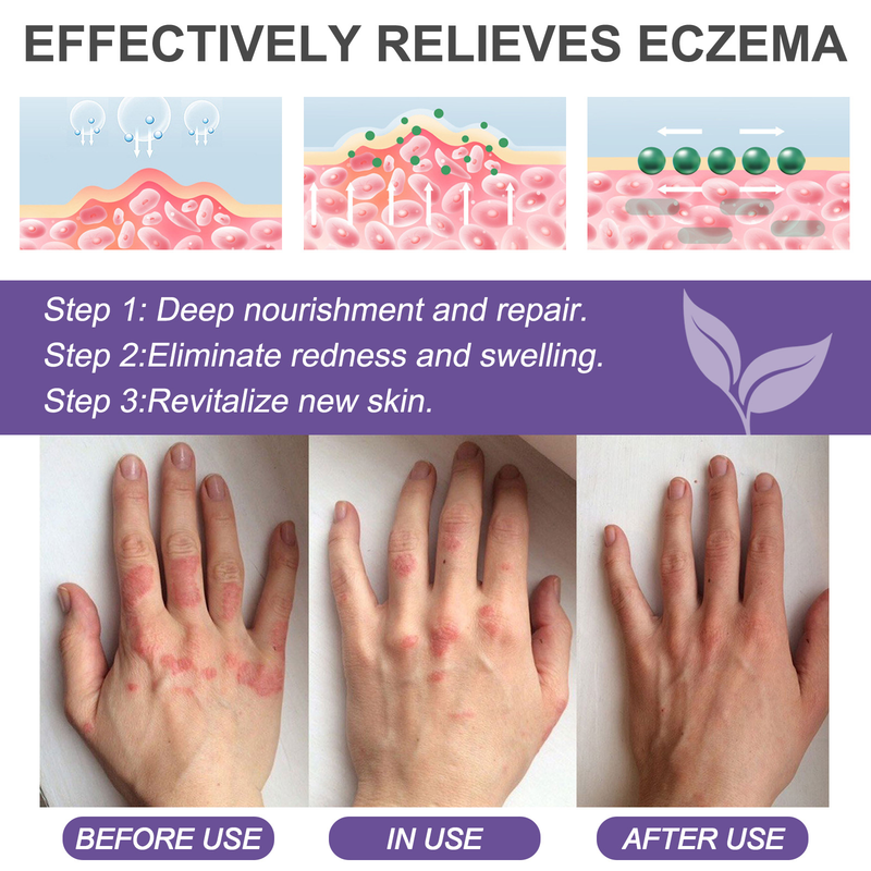 EELHOE Skin Repair Cream käte jalasambla parandamiseks, sügeluse ja punetuse leevendamiseks ning niisutav nahahoolduskreem_voghion.com