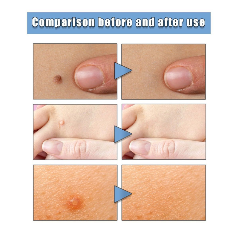 Remover, 24ss skin removal, removal of flesh thorns, flat skin, especially hand foot calluses, and chicken eye ,_voghion.com