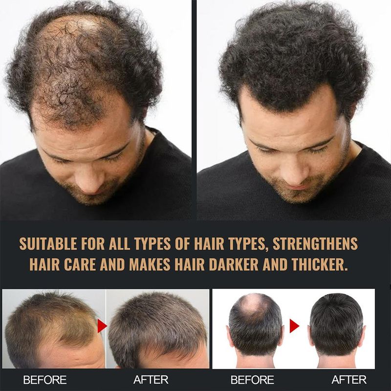2PCS Anti-Haarausfall-Shampoo, Verdickungsshampoo, Wurzelaktivator-Shampoo, nährendes Haarwachstums-Shampoo für dünner werdendes Haar und Haarausfall_voghion.com