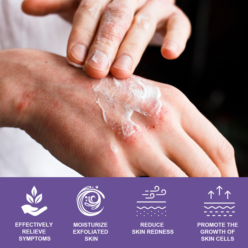 EELHOE Skin Repair Cream käte jalasambla parandamiseks, sügeluse ja punetuse leevendamiseks ning niisutav nahahoolduskreem_voghion.com