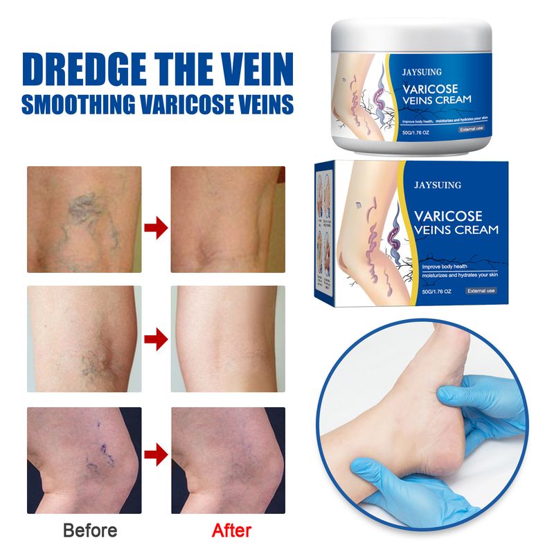 Para pernas de verme venoso com tendões e protuberâncias verdes, alívio da dor, hidratação com fio de sangue vermelho, reparo de protuberâncias, dor,_voghion.com