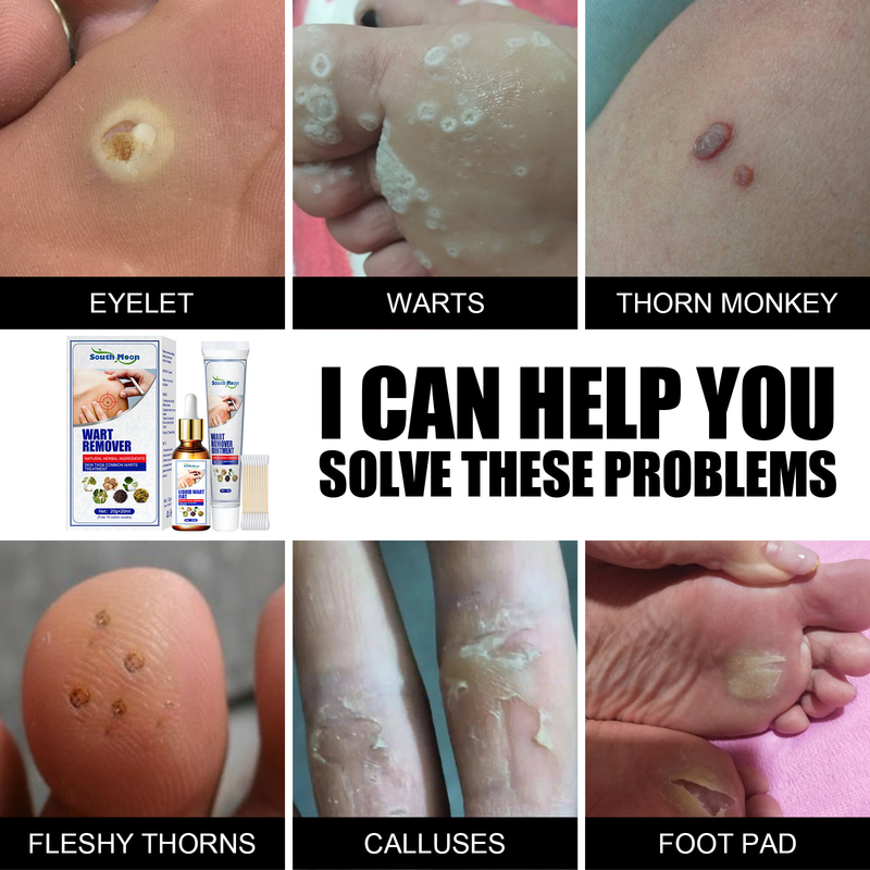 South Moon wart solution combination pack to remove acupoint warts, filiform warts, especially flat warts, fleshy thorns, corns eye cream essence_voghion.com