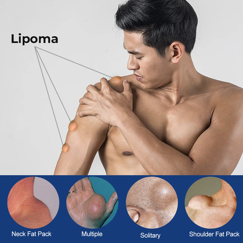 Knot Eliminating HBESTY Cream Relieving Subcutaneous Bulging of Fat Lumps and Granules_voghion.com