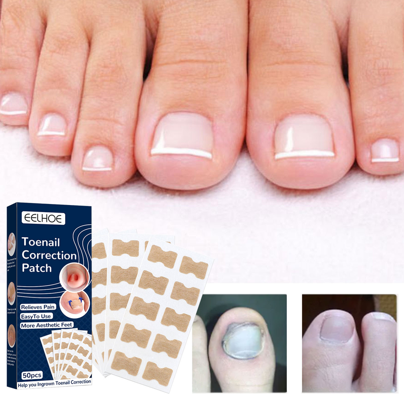 Boutique de soins de beauté Autocollants correcteurs pour ongles incarnés 50 pièces Patchs correcteurs pour ongles incarnés Traitement pour paronychie Recover Co_voghion.com