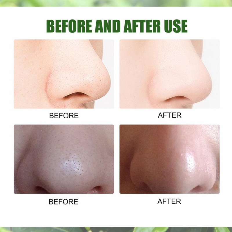 Serum za obnovu lica sa zelenim čajem, umirujući serum za kontrolu masnoće, serum za skupljanje pora, izbjeljivanje lica, uklanjanje tamnih mrlja, akni i mitesera, njega kože_voghion.com
