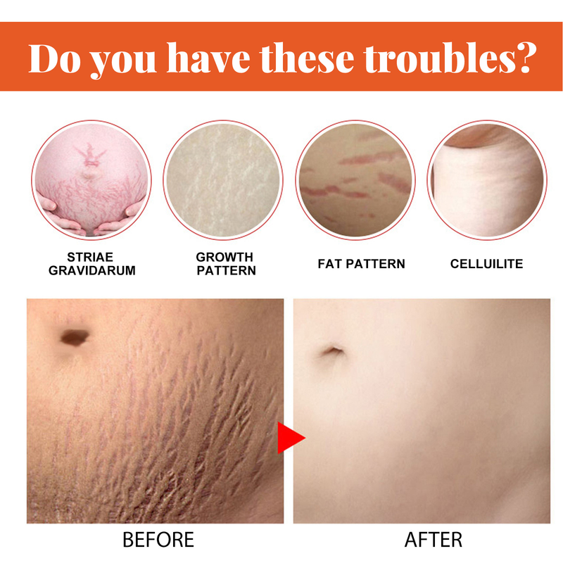 QLZHANFU Crème réparatrice contre les vergetures Crème pour la peau pour les femmes enceintes pour resserrer et desserrer les soins de la peau post-partum pour améliorer les rides_voghion.com