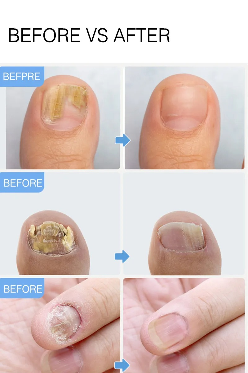 Essence de soin et de réparation des ongles à base de plantes, crème pour les ongles végétales_voghion.com