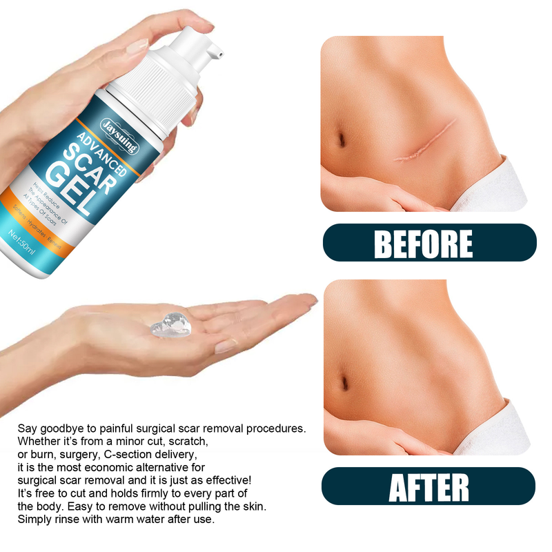 QLZHANFU Crème avancée d'élimination des cicatrices Boutons d'acné Réparation des vergetures Gel Brûlure Traitement chirurgical des cicatrices Lissage Beauté du corps Soins de la peau_voghion.com