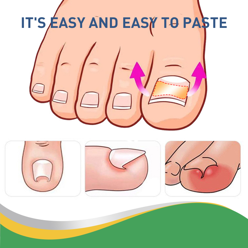 50Pcs Eingewachsene Zehennagel Corrector Aufkleber Fußpflege Paronychie Behandlung Pediküre Fuß Kieferorthopädische Kappe Daumen Nagel Auto_voghion.com