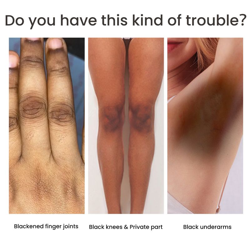 Körperbleichserum zur Verbesserung stumpfer, dunkler Haut, Aufhellung der Lippen, Achselhöhlen, Ellbogen, Knöchel, Oberschenkel, Knie, Intimbereiche, private Aufhellungsessenz_voghion.com