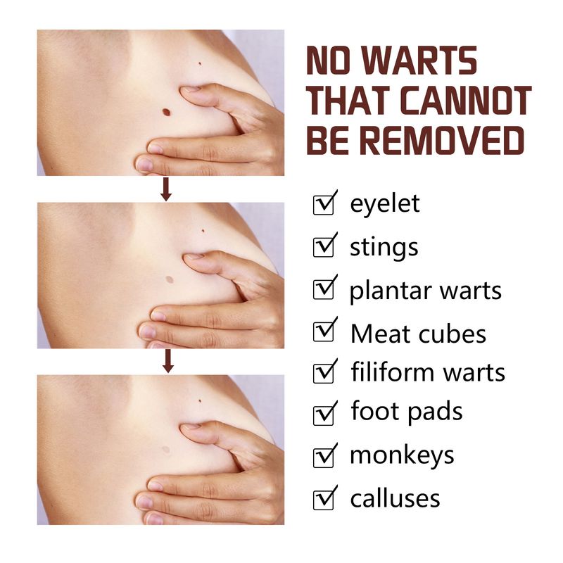 South Moon vårtkräm djuprengörande av hud, svarta nevi och kycklingögonreparation för len hud_voghion.com