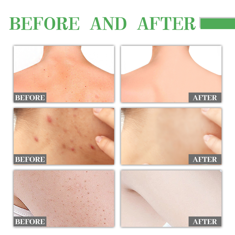 Jayswing Acne Removing&Whitening can lighten spots, acne marks, moisturize and whiten skin essence_voghion.com