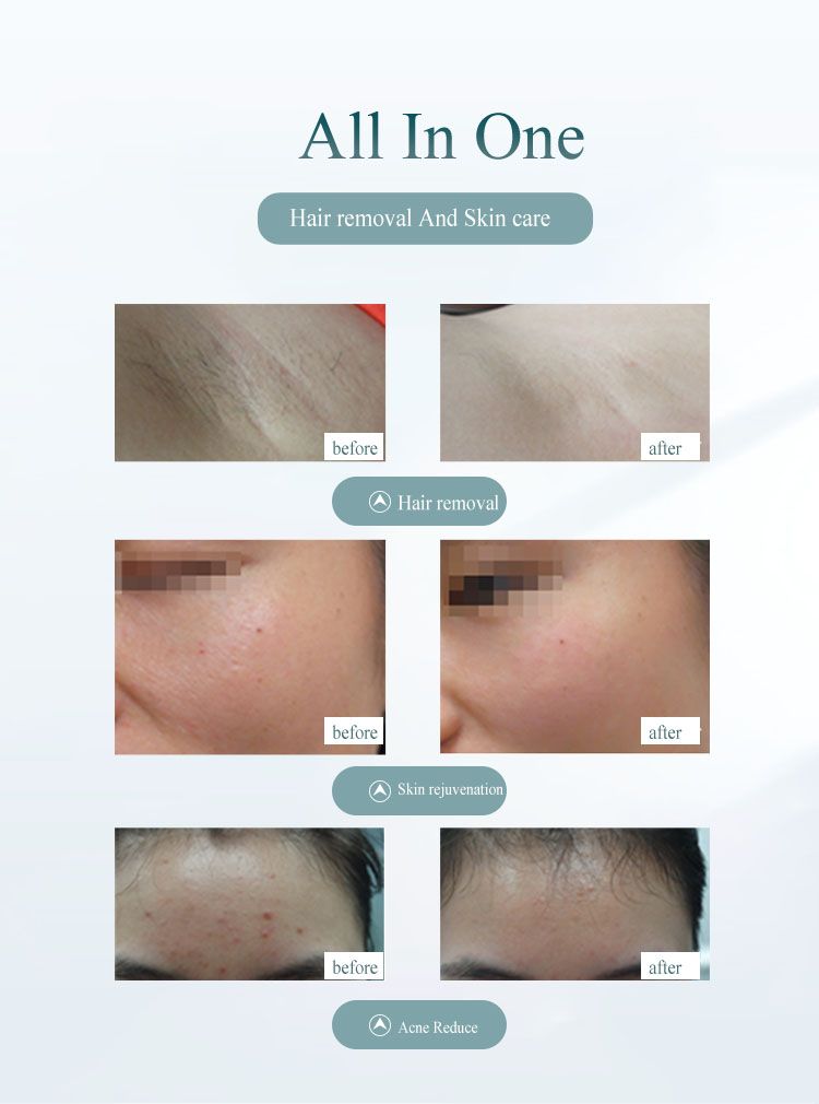 Pro frauen gesichts körper IPL haar entfernung laser epilierer foto haar eltávolító menetvágó gép beine männer enthaarung gerät_voghion.com
