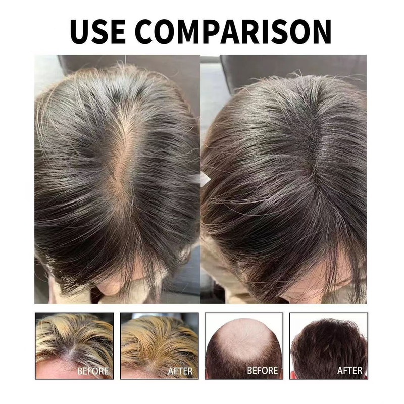 Il siero per il trattamento della caduta dei capelli Jaysuing aumenta la densità dei capelli e riduce la caduta dei capelli_voghion.com