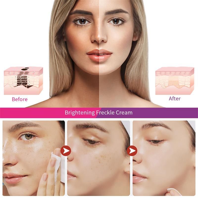 Nikotinamid Hvidningscreme til fjernelse af fregner Fjerner effektivt melasma Mørke pletter Aknemærker Lysner melanin Ansigtshudpleje_voghion.com