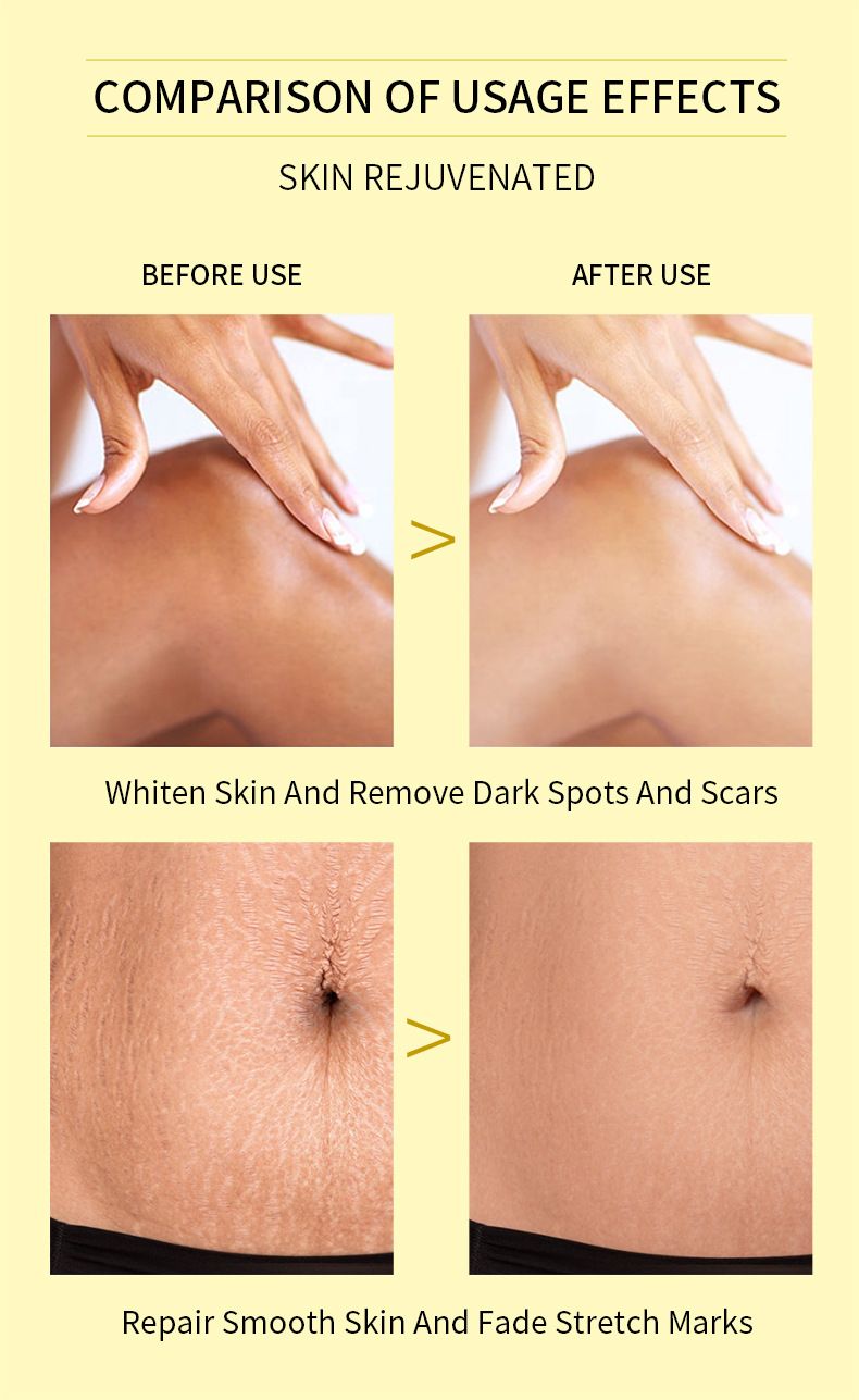 Bsncpley Peeling Yağı Beyazlatıcı Peeling Peeling El Yüz Vücut Peeling Esans Yağı Cildi Yatıştırır_voghion.com
