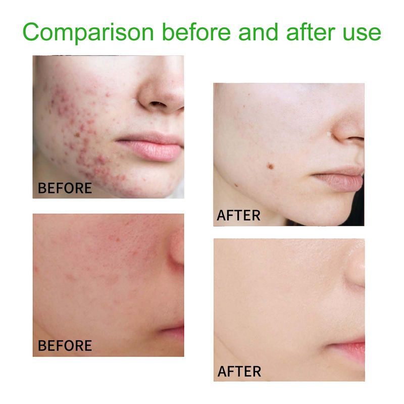 Il detergente anti-acne EELHOE deterge in profondità sebo, sporco, punti neri, brufoli, restringe i pori, è rinfrescante e confortevole._voghion.com
