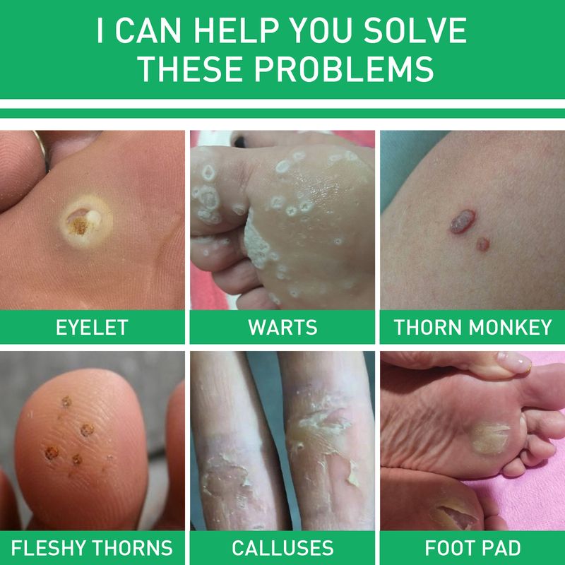 Jaysuing Mild Wart Removing Chicken Eye Smooth Skin and Foot Care Liquid_voghion.com